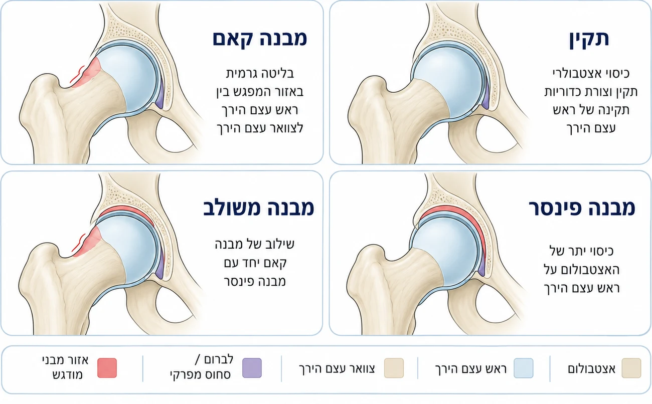 איור השוואתי של ארבעה מצבי מפרק ירך: מבנה תקין, מבנה קאם עם בליטה גרמית בצוואר עצם הירך, מבנה פינסר עם כיסוי יתר של האצטבולום, ומבנה משולב